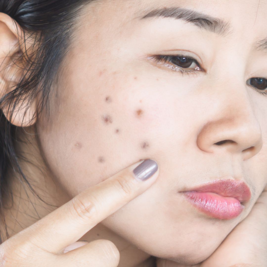 Acne & Breakouts