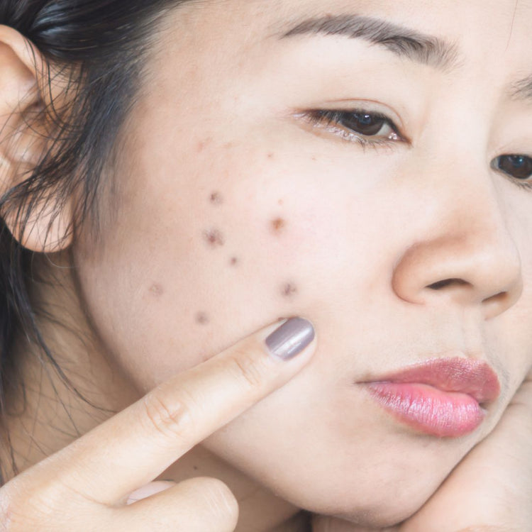 Acne & Breakouts