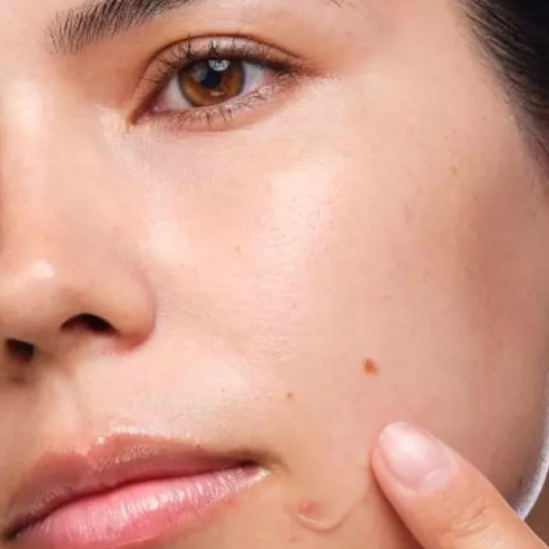 Pigmentation & Uneven Skin Tone